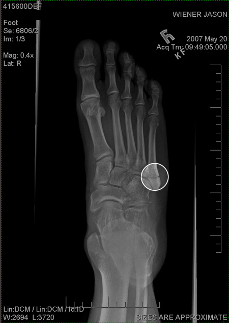 foot fracture bay to breakers 2007